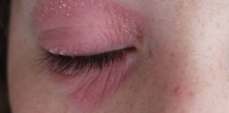 Eyelid Dermatitis Symptoms And How Long Does It Take To Go Away