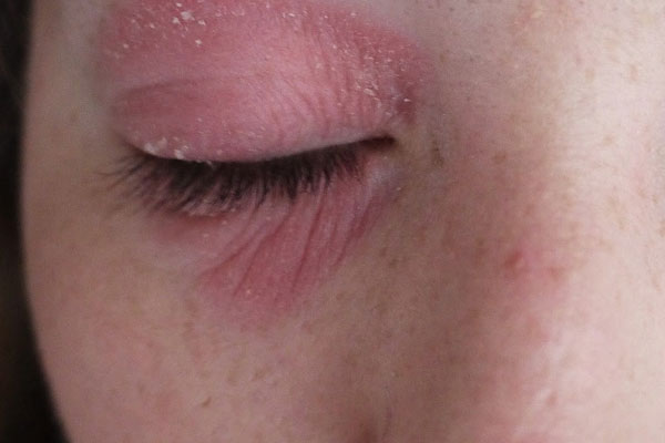 Eyelid Dermatitis Symptoms And How Long Does It Take To Go Away