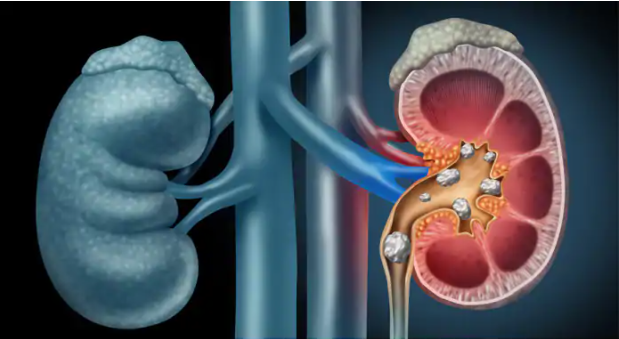 5 Ways How to Get Rid Of Kidney Stones At Home